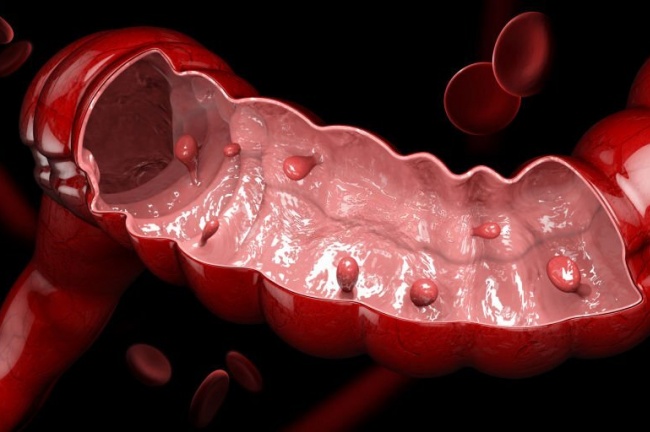 Você pode ter pólipos intestinais e sequer imagina!