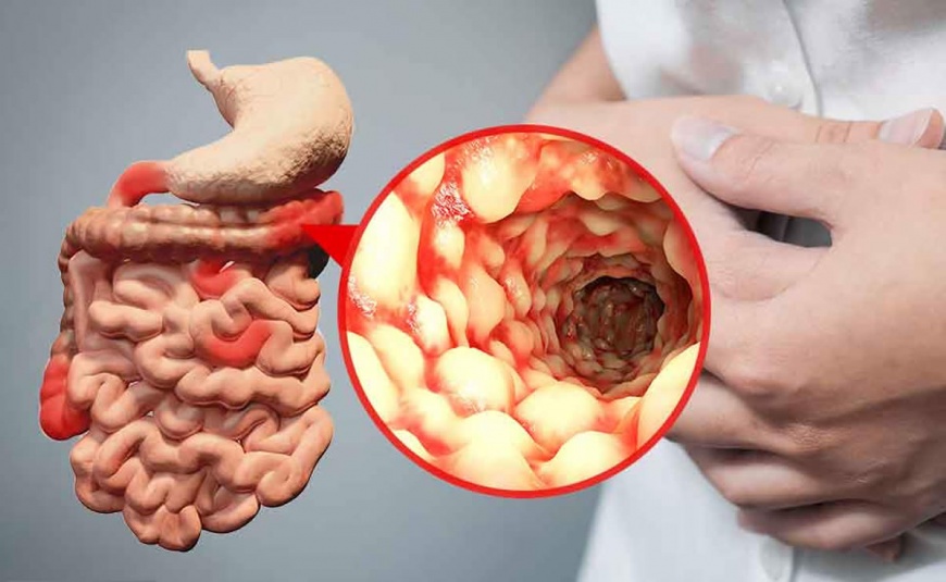 Doença de Crohn